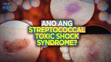 callcenter@doh.gov.ph|DOH: Streptococcal toxic shock syndrome not yet a health .